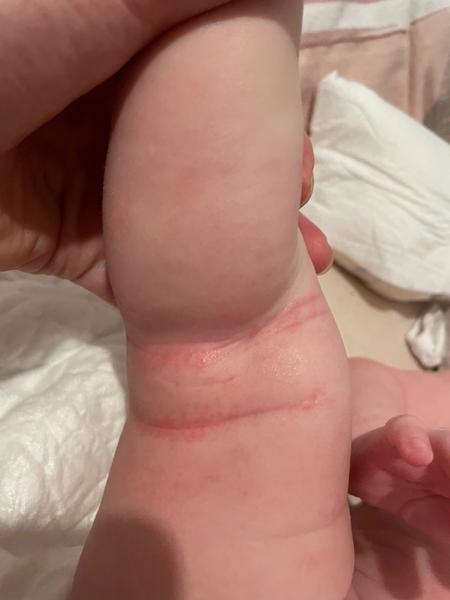 Ekzém nebo kvasinka?