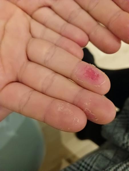 Loupající se bříška prstů u dětí. Jaké jsou příčiny?