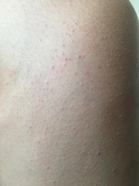 Nevysvětlitelné svědění a skvrny na pokožce: Poradíte?