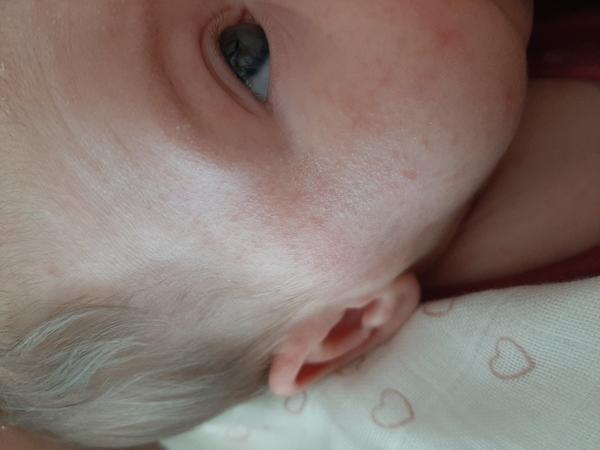 Potničky nebo ekzém?