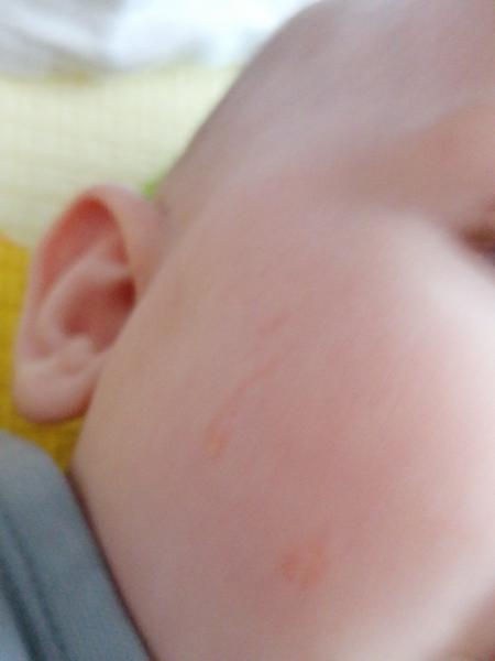 Pupínky na tvářičkách. Neměl někdo něco podobného?