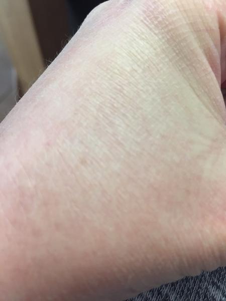 Fleky po celém těle. Co by to mohlo být?