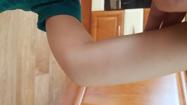 Fleky. Co to může být?