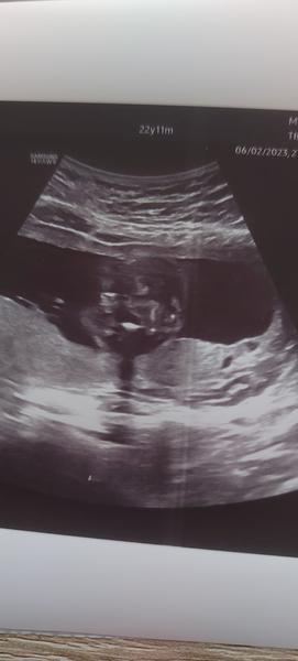 Jak zjistit pohlaví z ultrazvuku ve 21. týdnu?