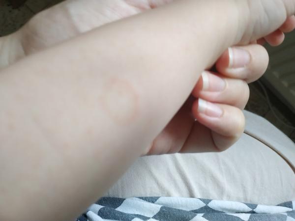 Flek na ručičce. Mám volat doktorce?