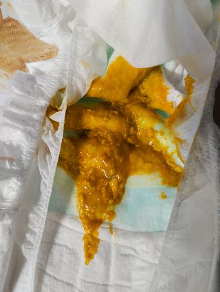 Kojené dítě. Má mít kyselou a hlenovitou stolici?