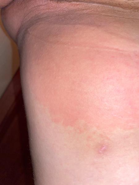 Máte svědivé problémy při menstruaci. Mohlo by jít o svrab?