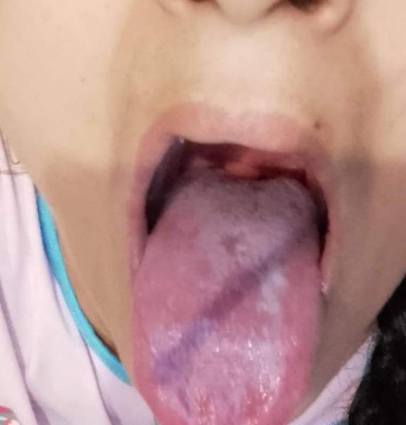 Může bolest v krku znamenat angínu?