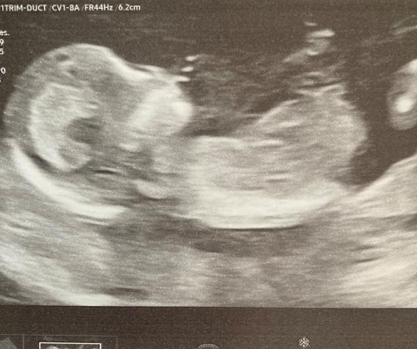 Ultrazvuk 12. tt. Zdá se skutečně poznat podle pahorku pohlaví plodu?