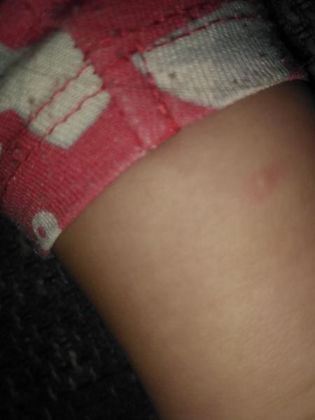 Ekzém nebo neštovice?