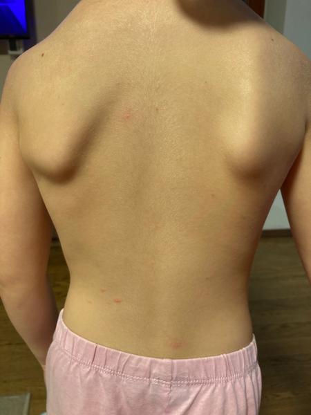 Svědivé pupínky. Co by to mohlo být?