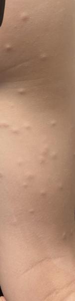 Pupínky na stehnech a břiše u tříletého syna. Co dělat?