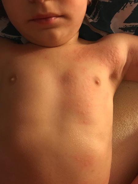 Vyrážka jen na pár hodin u 3leté dcery