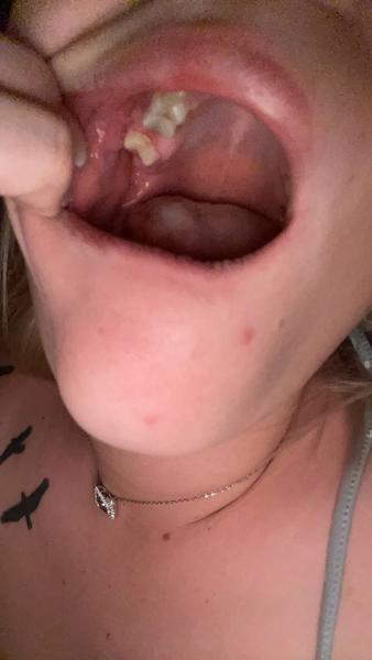 Stále bolí zuby po 3 měsících? Co dělat?