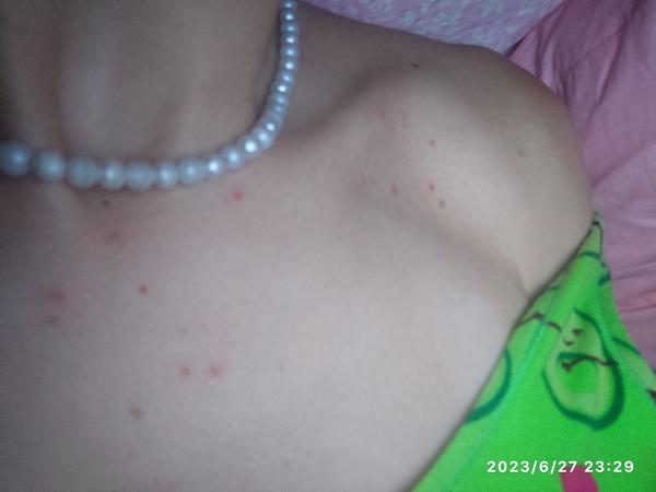 Co způsobuje červené pupínky na hrudi a zádech?