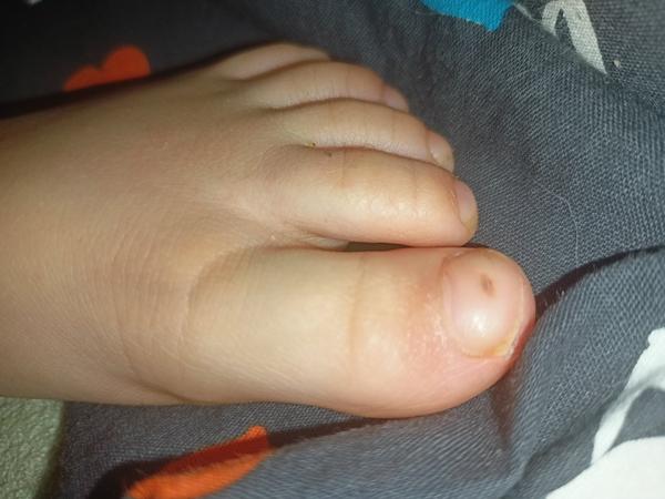 Hnědý flek na palci. Nevíte, o co jde?