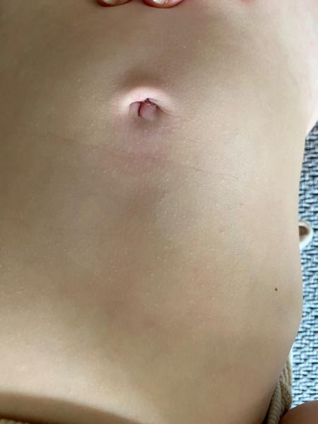 Jak léčit štípance od sametky či svilušky u dětí?