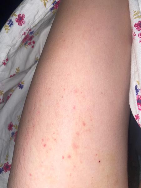 Svědění na těle. Může to být svrab?