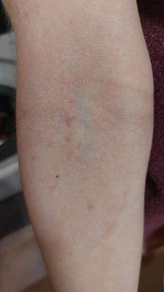 Pupínky u atopického ekzému. Mohou to být molusky?