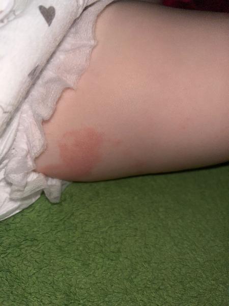 Vyrážka u dítěte. Jak řešit zhoršení po masti?