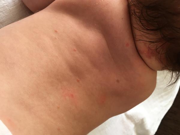 Boláky pod krkem. Zkušenosti? Prosím, pomůžete?