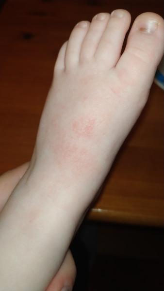 Fleky na těle dítěte. Fucidin ani Locoid nepomohly. Jak postupovat dále?