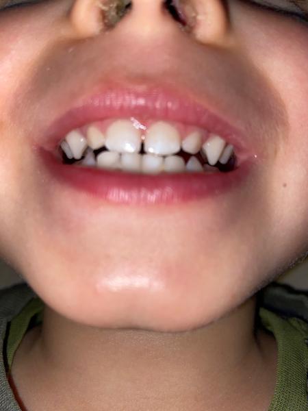 Jak zabránit vzniku medových zubů u dětí?