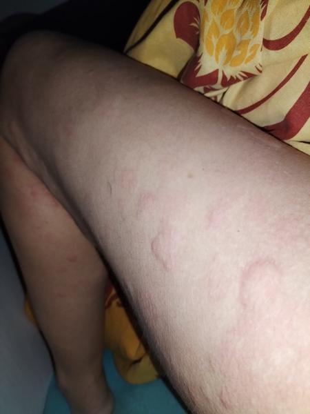 Jak řešit svědivou vyrážku na začátku těhotenství?