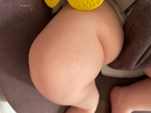 Co způsobuje fleky na kůži u kojenců?