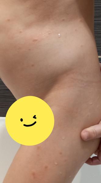 Pupínky u dítěte. Mohou to být neštovice?