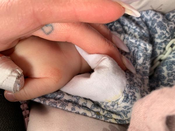 Jak řešit suchá místa a ekzém u miminka?