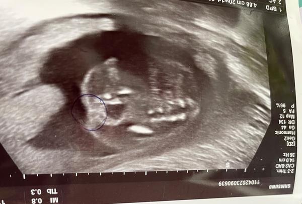 Chlapec nebo děvče?