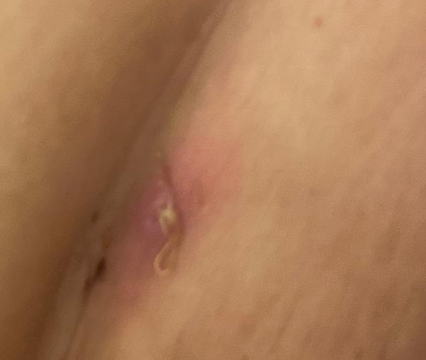 Hnis u stehu po císaři. Mám vyhledat lékaře?