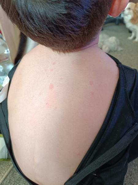 Fleky na hrudi a zádech bez svědění. Co to je?