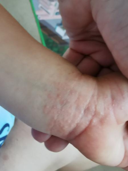 Rychle se šířící vyrážka u dětí. Jak řešit?