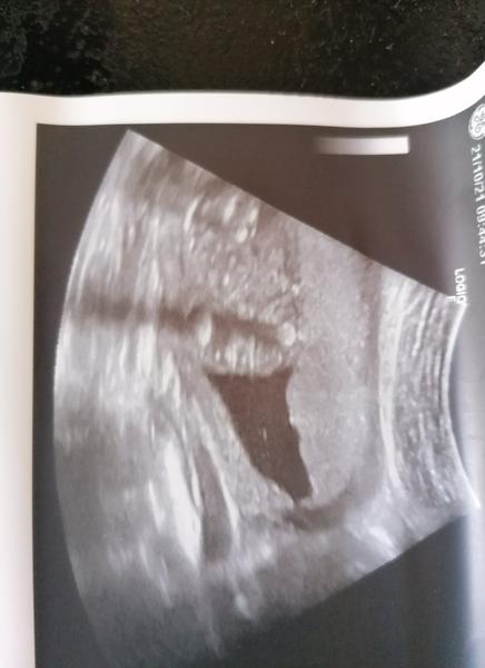 Holčička nebo chlapeček: Jak určit pohlaví z ultrazvuku?