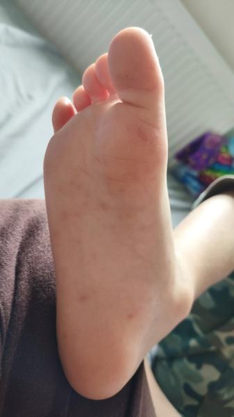 Je vyrážka na dlaních příznakem sedmé nemoci?