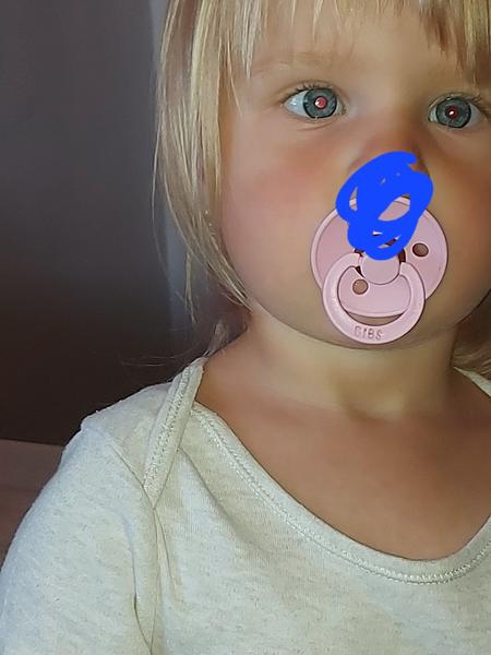 Flíček na tváři u 23měsíční: Co může znamenat?