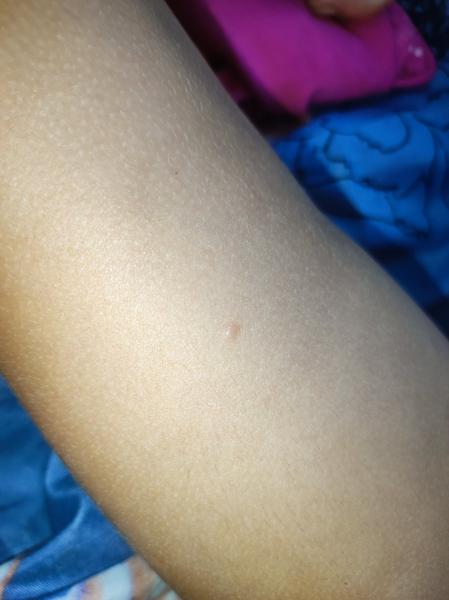 Mohou být pupínky na nožičkách dcery alergií?