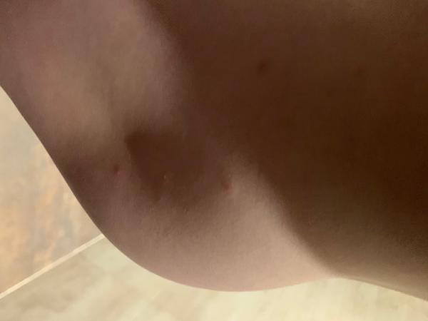 Vyrážka. Na co dalšího se zaměřit?