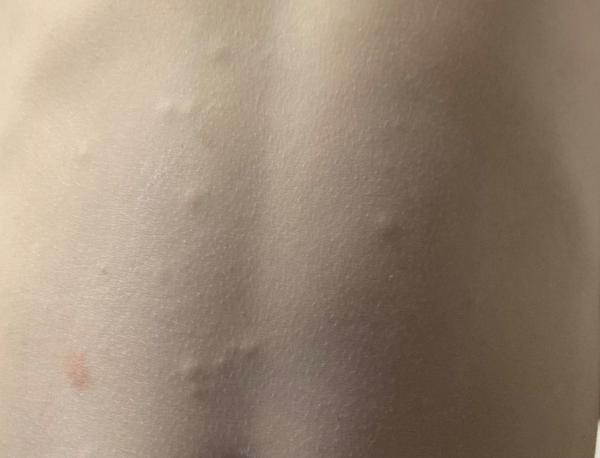 Pupínky na stehnech a břiše u tříletého syna. Co dělat?