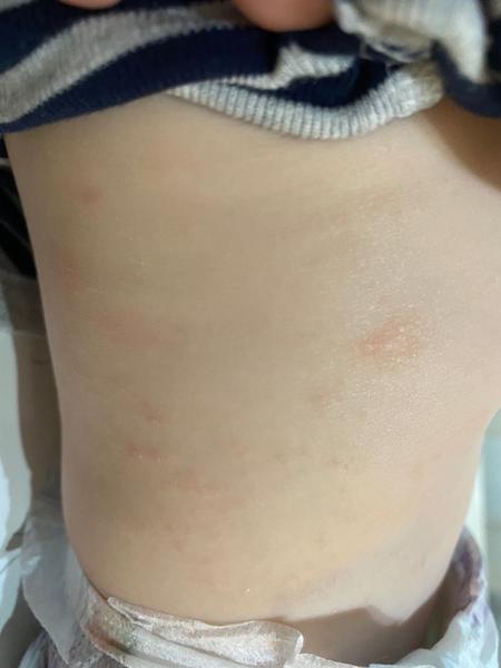 Vyrážka. Co by to mohlo být a jak řešit?