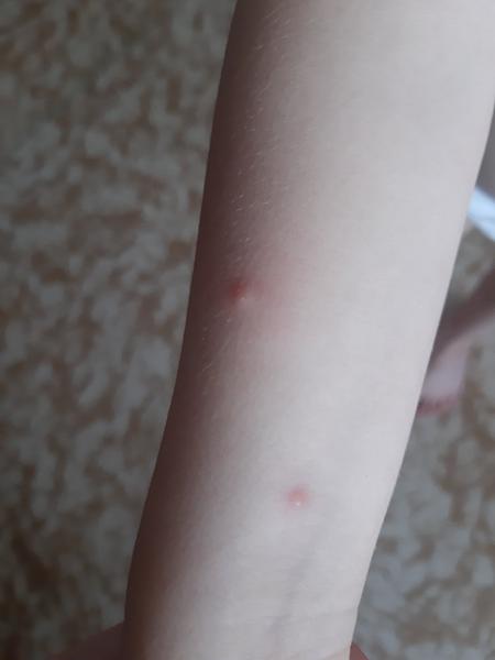 Mohou pouze pupínky u dcery znamenat neštovice?