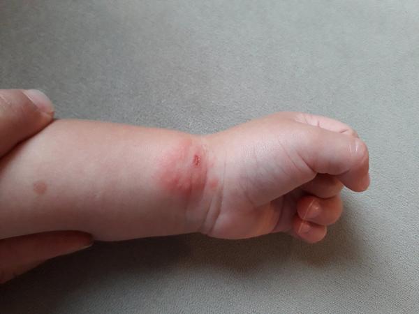 Bolák na ruce u 2letého dítěte. Co by to mohlo být? Čím mazat?