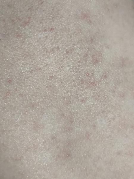 Vyrážka nebo ekzém u dětí. Jak zmírnit?