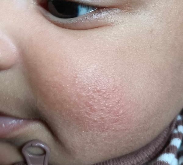 Zinková mast a vyrážka u miminka. Pomáhá opravdu?