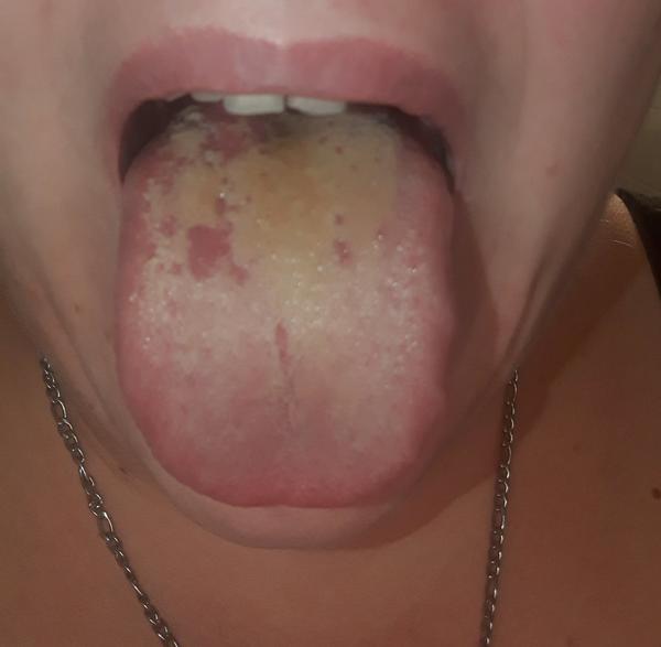 Skvrny na jazyku. Nevíte, co to je?