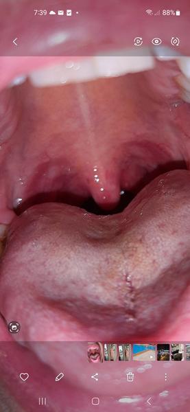 Mám třetí den vysokou horečku. Je to angína?