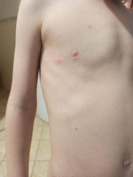 Léčba neštovic u dětí: Který gel použít?