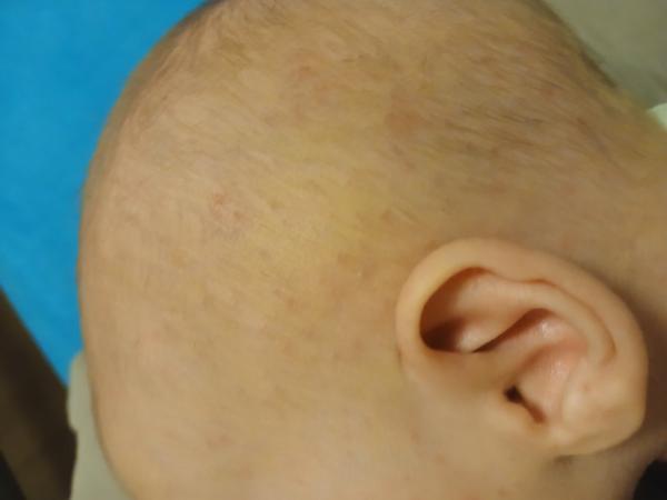 Seborea / novorozenecké akné / ABKM. Co by to mohlo být?